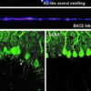 Found: a genetic link to molecular events that precede symptoms in Alzheimer's disease