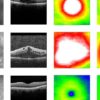 Novel deep learning method enables clinic-ready automated screening for diabetes-related eye disease