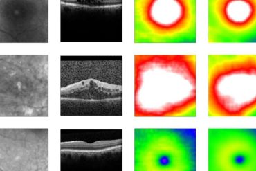 Novel deep learning method enables clinic-ready automated screening for diabetes-related eye disease