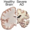 Illustration showing how a brain with Alzheimer's disease shrinks.