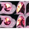 PET and CT scans provide keen views of lungs with active TB, and are better assessment tools than sputum tests