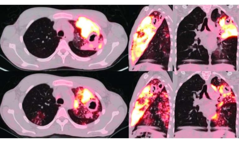 PET and CT scans provide keen views of lungs with active TB, and are better assessment tools than sputum tests