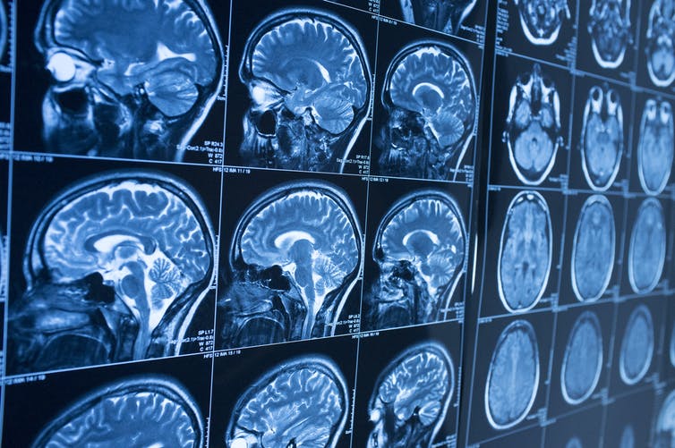 Brain MRI images showing multiple views