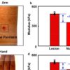 Detecting skin disorders based on tissue stiffness with a soft sensing device