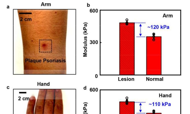 Detecting skin disorders based on tissue stiffness with a soft sensing device
