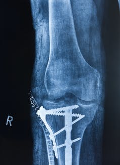 An X-ray of a knee shows elaborate hardware including four long screws in the lower bone and a series of staples near the hardware