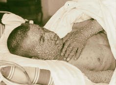 19th-century photo of a smallpox patient