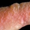 pink rash with blisters on skin close up