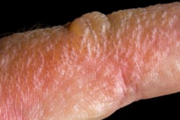 pink rash with blisters on skin close up