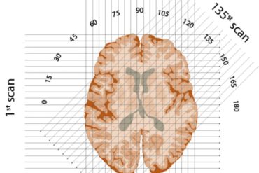 schematic of three X-ray beams through one 'slice' of brain