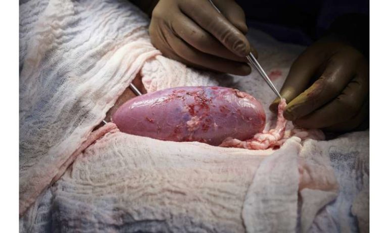 Pig-to-human transplants come a step closer with new test