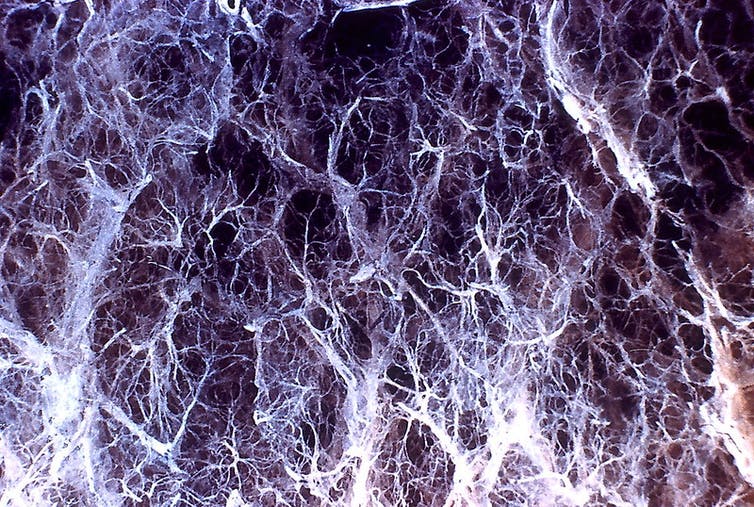 Microscopy image of panlobular emphysema