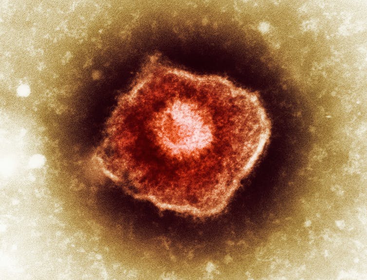 TEM image of varicella zoster virus