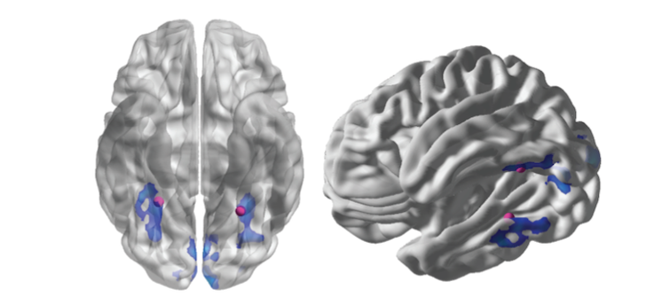 Functional magnetic resonance image of brain, showing activity in the areas of the brain involved in repetition suppression