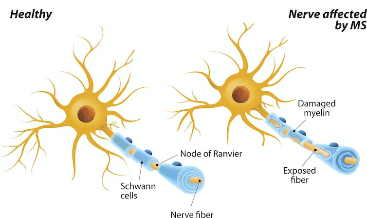 Diagram comparing healthy nerve and nerve affected by multiple sclerosis