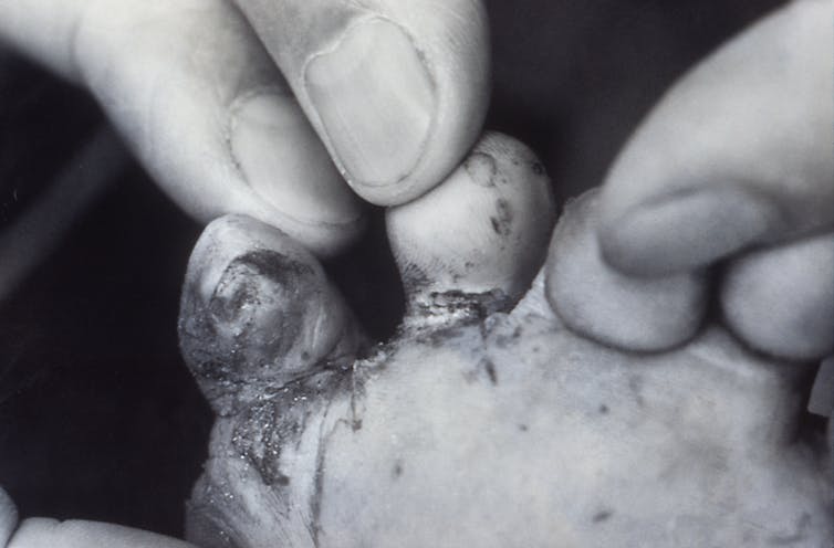 bottom of a child's foot showing open lesions by the toes