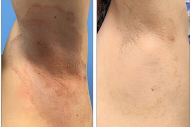 Experts alert doctors and the public to the arrival of hard-to ...