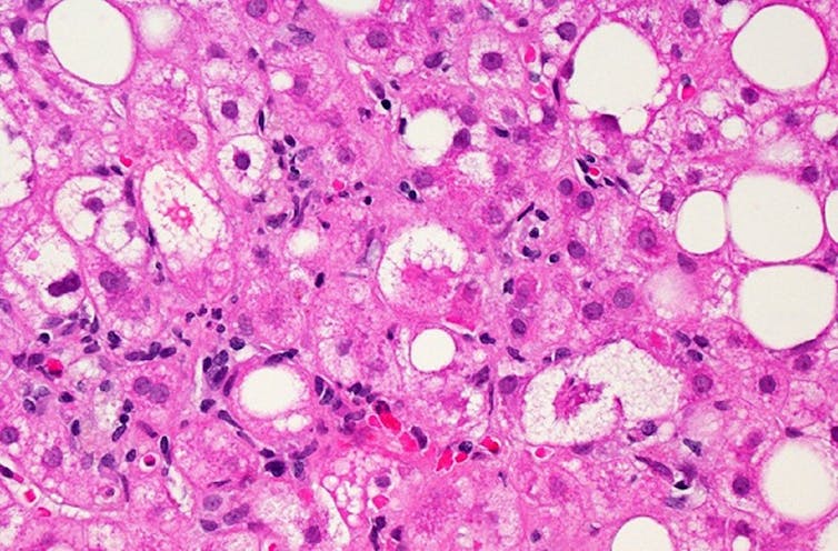 Microscopy image of liver cells affected by MASLD, some otherwise spherical pink cells distended with white fat deposits