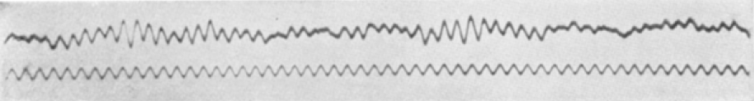 This is among the first EEG readings published in Hans Berger's study. The top trace is the EGG while the bottom is a reference trace of 10 Hz.
