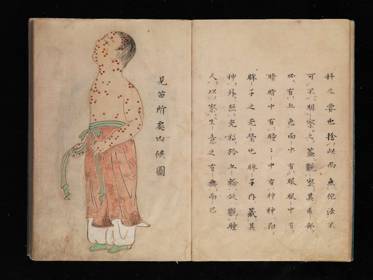 Scan of yellowed book pages with illustration of person covered in smallpox pustules on left page and Japanese text on the right