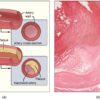 Metals in the body from pollutants associated with progression of ...