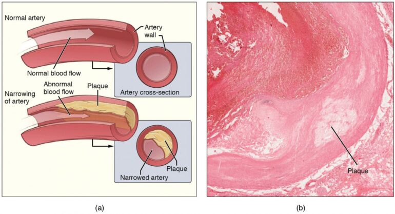 Metals in the body from pollutants associated with progression of ...