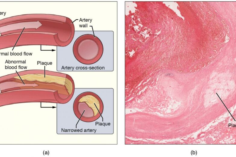 Metals in the body from pollutants associated with progression of ...