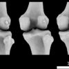 Tiny knee bone linked to osteoarthritis 'may have helped humans ...