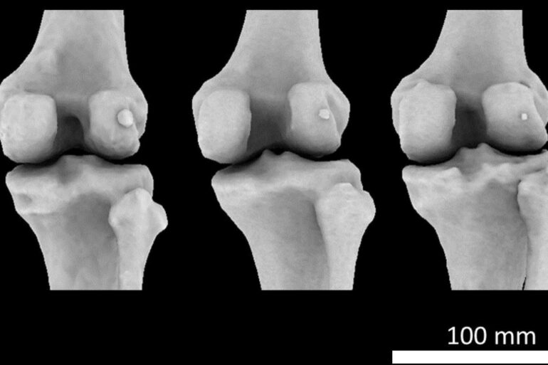 Tiny knee bone linked to osteoarthritis 'may have helped humans ...