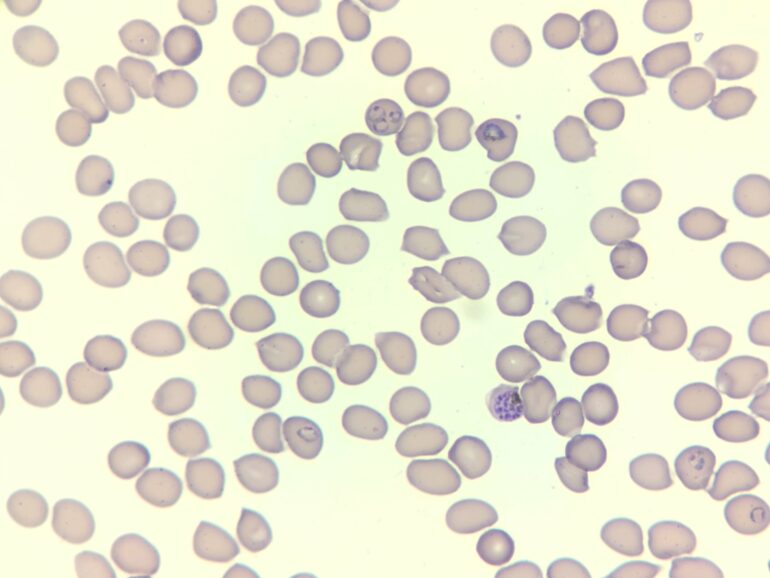 Discovery of critical iron-transport protein in malaria parasites ...