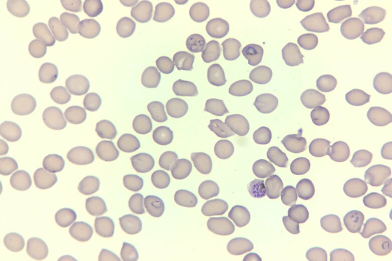 Discovery of critical iron-transport protein in malaria parasites ...