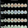 Structural connections in the brain in relation to gender identity ...