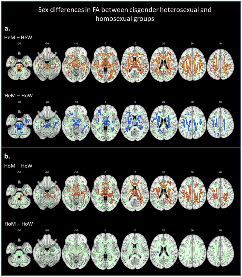 Structural connections in the brain in relation to gender identity ...