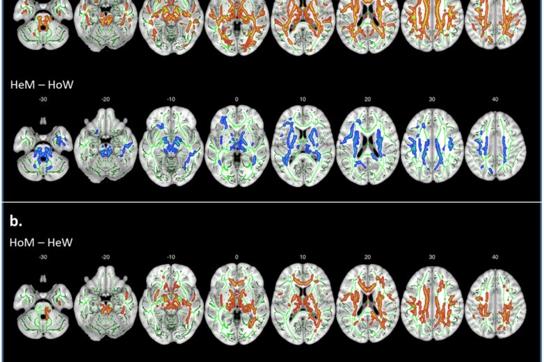 Structural connections in the brain in relation to gender identity ...