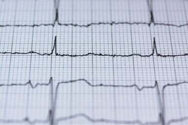 Why is obesity linked to irregular heart rhythms? Researchers ...