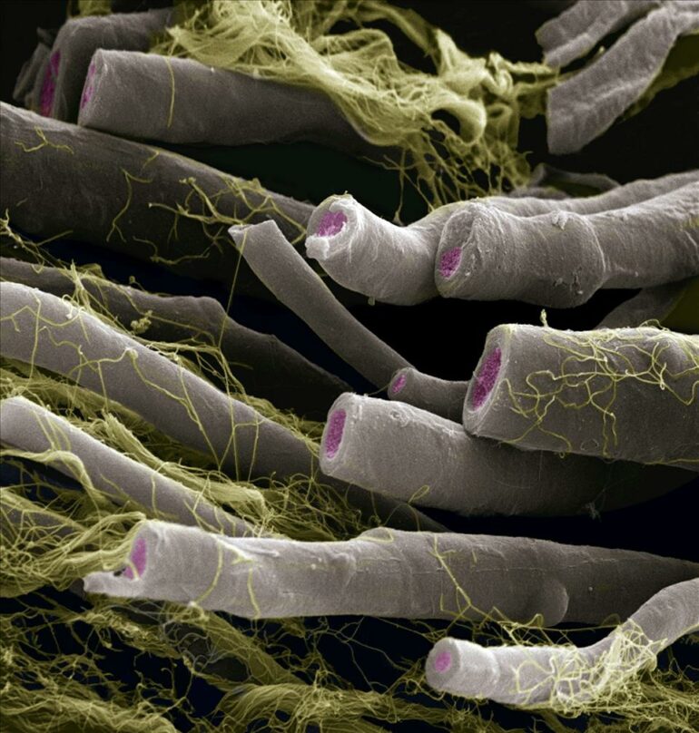 Out-Of-Balance Bacteria Is Linked To Multiple Sclerosis − The ...