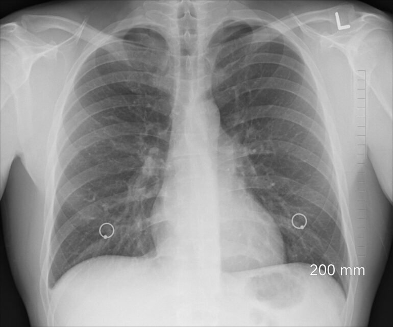 Lung cancer screening lags behind breast and colorectal screenings