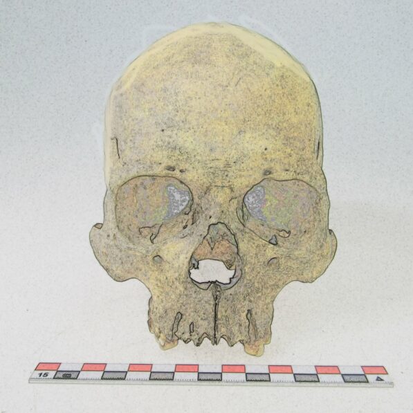 Ancient DNA reveals rare leprosy strain existed in the Americas ...