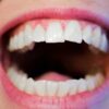 Sugar starts corroding your teeth within seconds. Here's how to ...