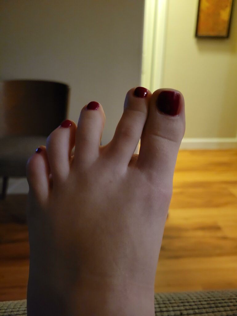 Toes keep cramping and moving to the side in their own. I can't ...