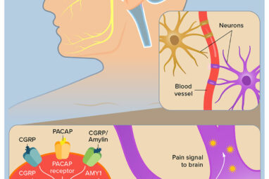 Studies of Migraine's Many Triggers Offer Paths to New Therapies