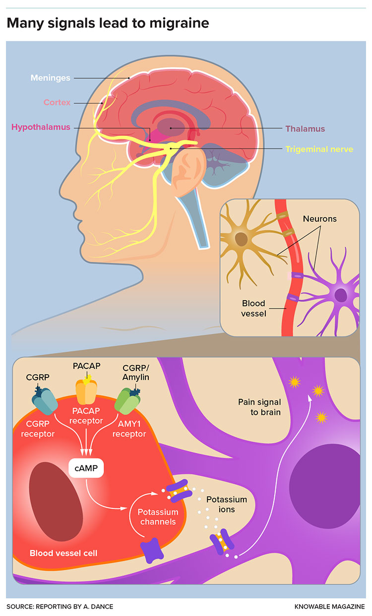 Studies of Migraine's Many Triggers Offer Paths to New Therapies
